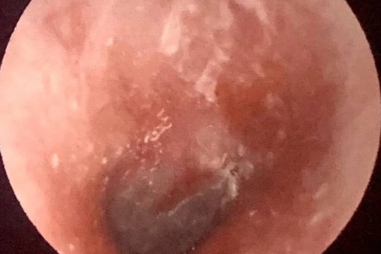 小孩急性外耳道炎图