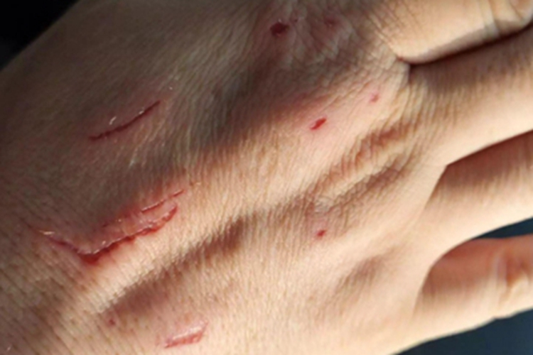 抓伤手背裂口图