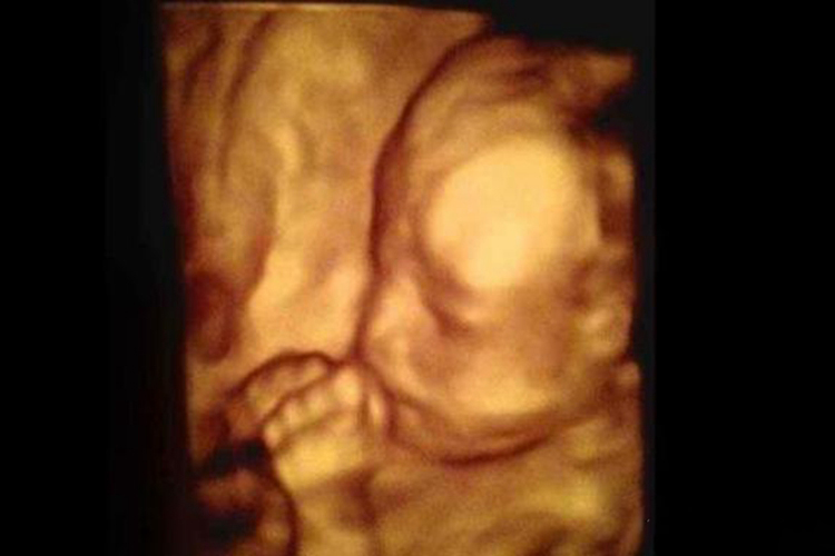 怀孕19周胎儿彩超图 怀孕19周胎儿彩超图