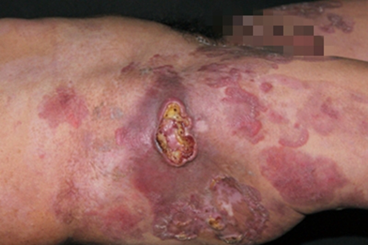 蕈样肉芽肿溃疡图