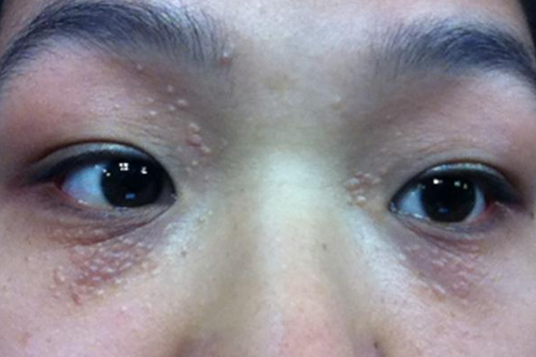 眼睛下面长小颗粒图片