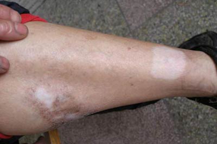 白癜风小腿白斑图