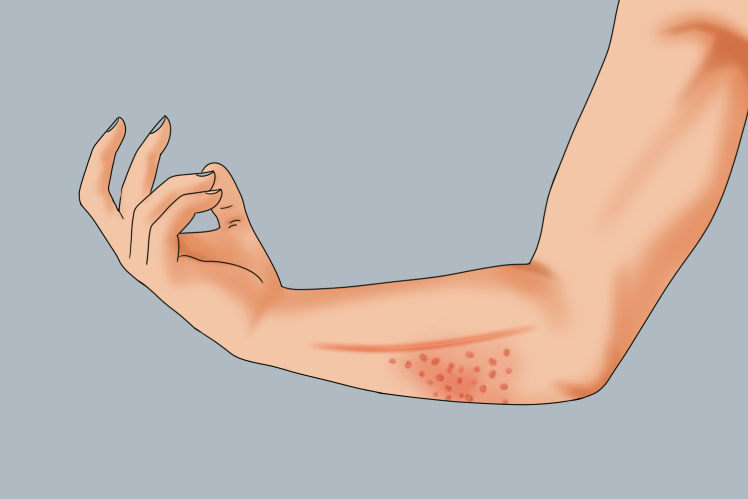 手臂上湿疹图 手臂上湿疹图