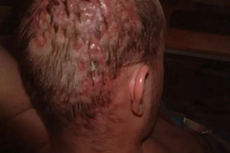 脱发性毛囊炎红肿图