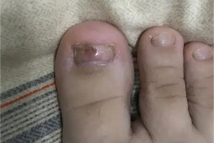 慢性化脓性甲沟炎红肿图