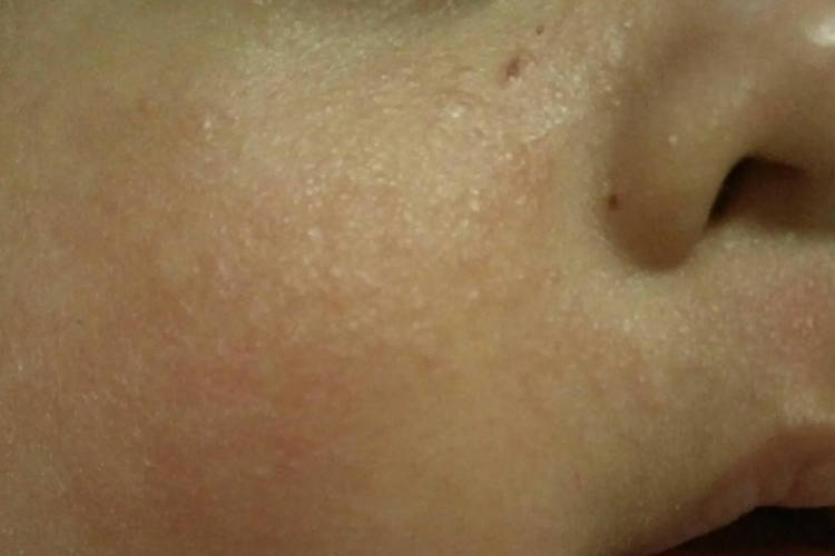脸上深痱图 脸上深痱图