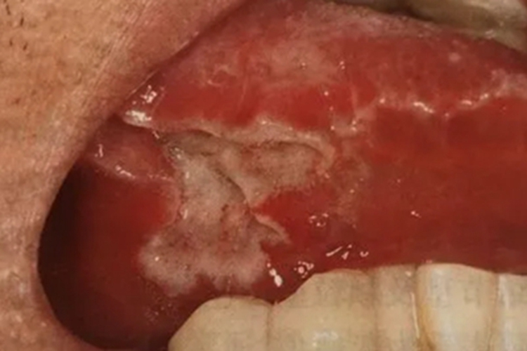 坏死性溃疡性龈口炎舌头溃疡图