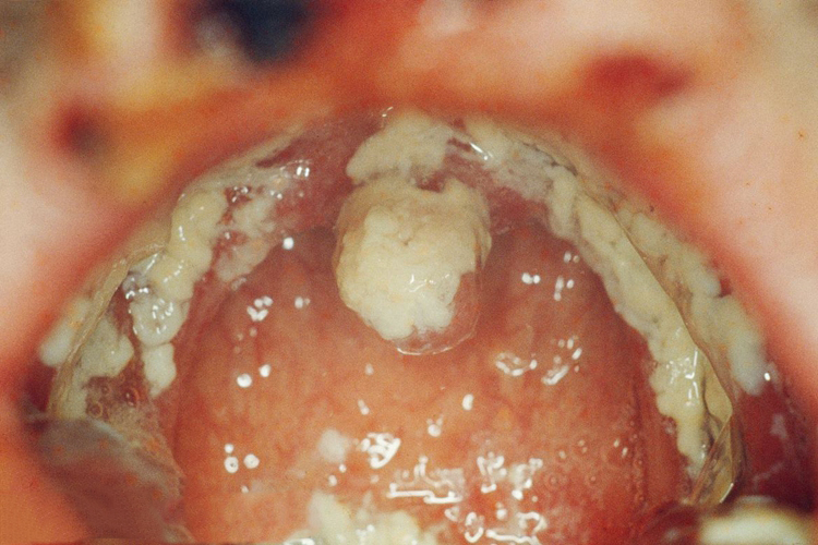 艾滋病口腔念珠菌感染图