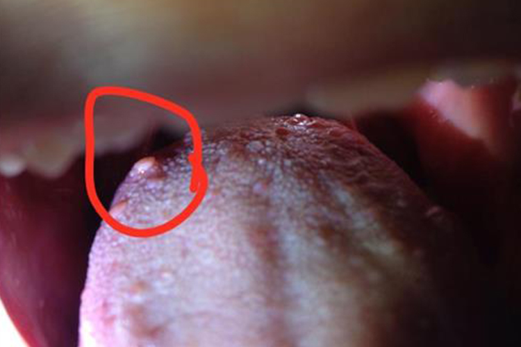 舌乳头炎舌侧长息肉图 舌乳头炎舌侧长息肉图