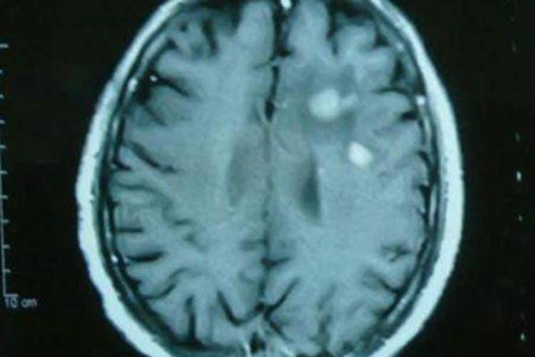 棘球蚴病头部症状图