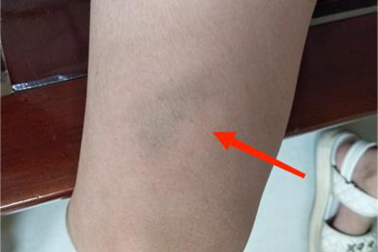 撞伤腿部症状图