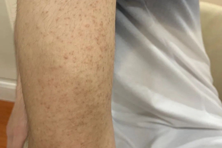 毛囊角化病胳膊斑图