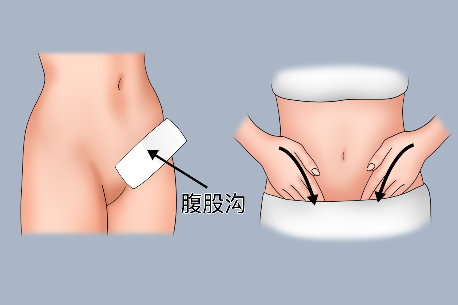 酒精降温擦拭腹股沟图