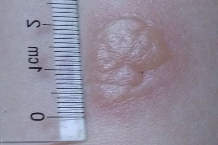 结核菌素试验强阳性硬结图