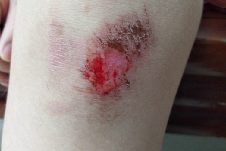 跌伤膝盖结痂图