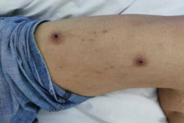 恙虫病大腿症状图