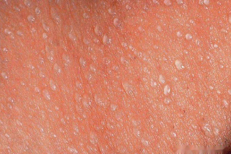 水晶痱子图 水晶痱子图