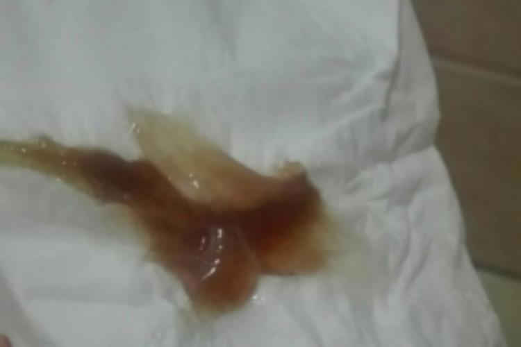 先兆流产褐色分泌物图