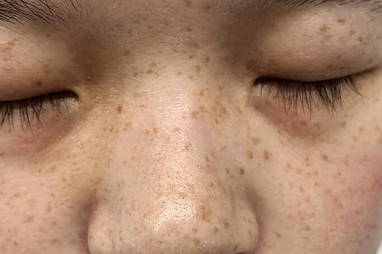 脸部雀斑图