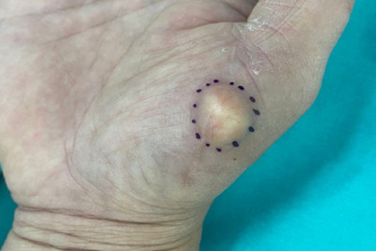 表皮样囊肿手掌症状图