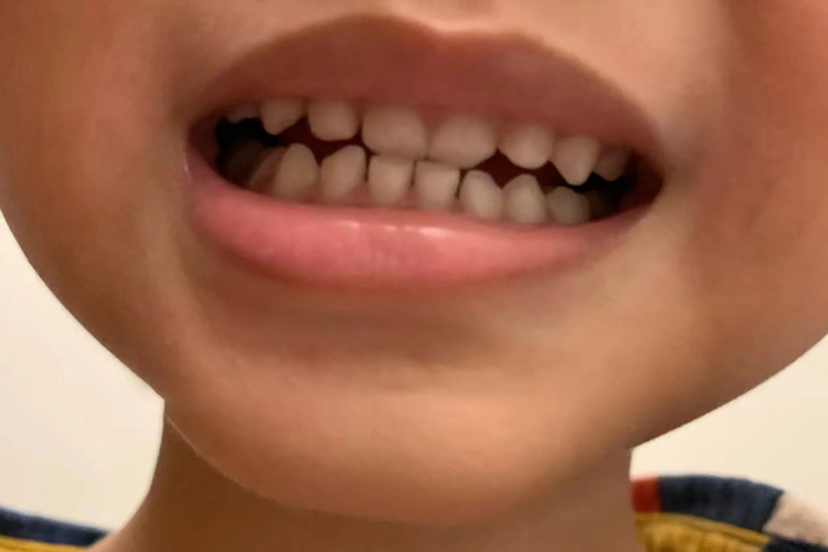 双排牙矫正恢复图