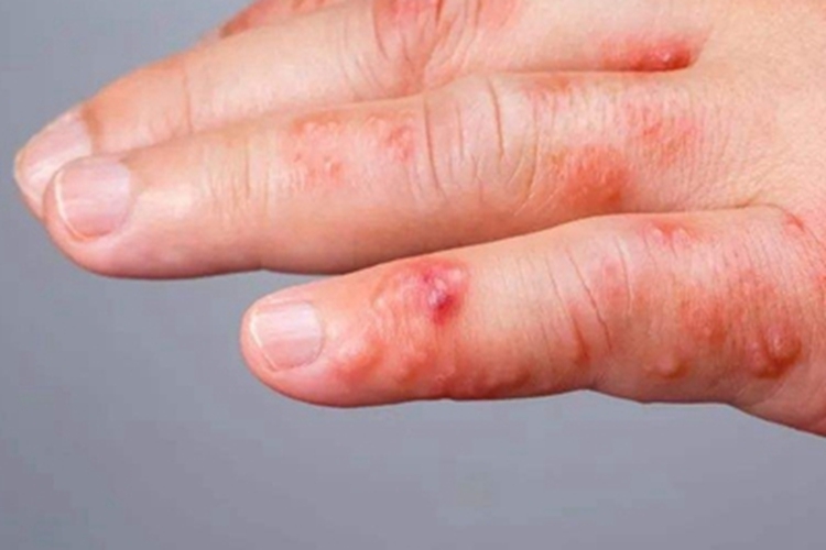 牛痘样水疱病典型轻型手指红肿图
