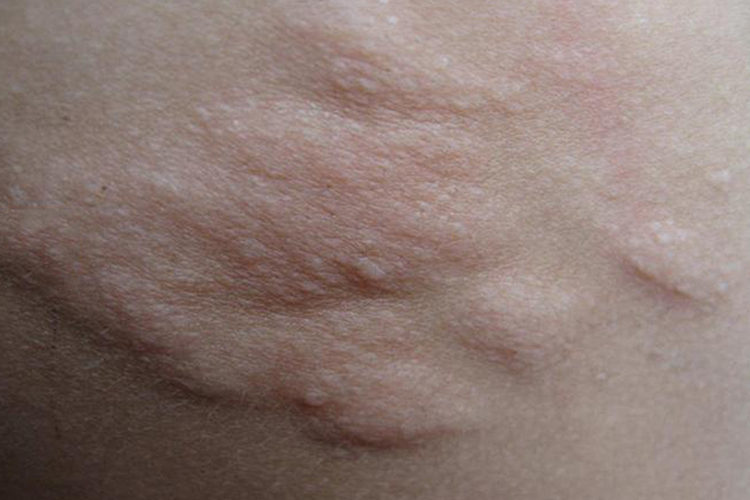 结节性硬化鲨革斑图