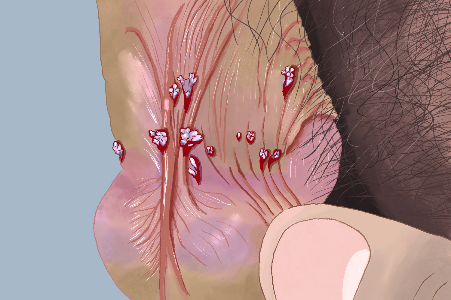 阴囊尖锐湿疣图