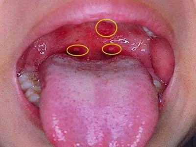 疱疹性咽炎的症状和图片 - 有来医生