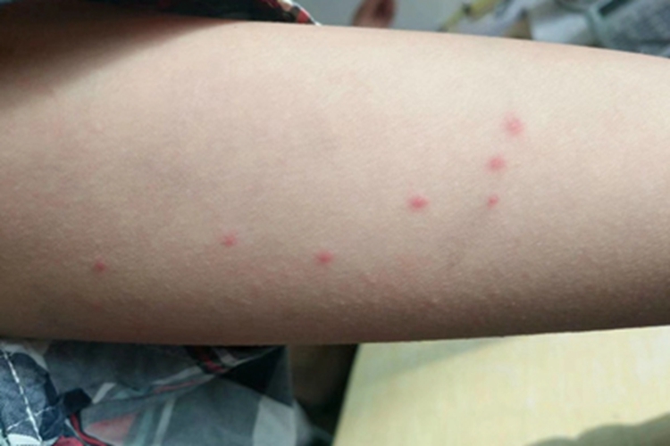 蚊虫叮咬小红疙瘩图