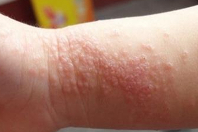 桑毛虫皮炎丘疹图