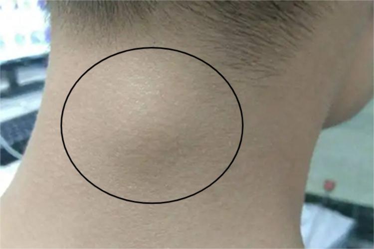 颈部纤维瘤肿块图