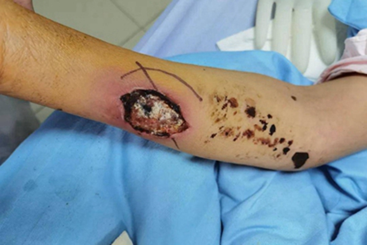 小螺菌型鼠咬热血痂图 小螺菌型鼠咬热血痂图