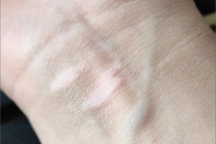 稳定期节段型白癜风手腕症状图 稳定期节段型白癜风手腕症状图