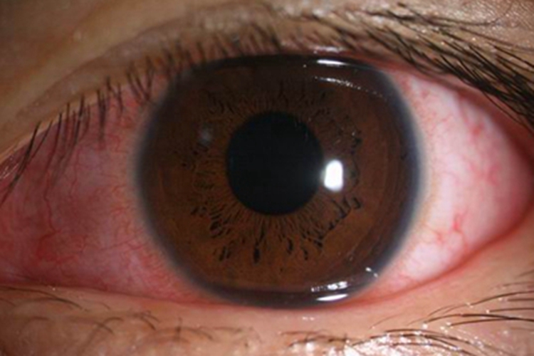 慢性细菌性结膜炎充血图