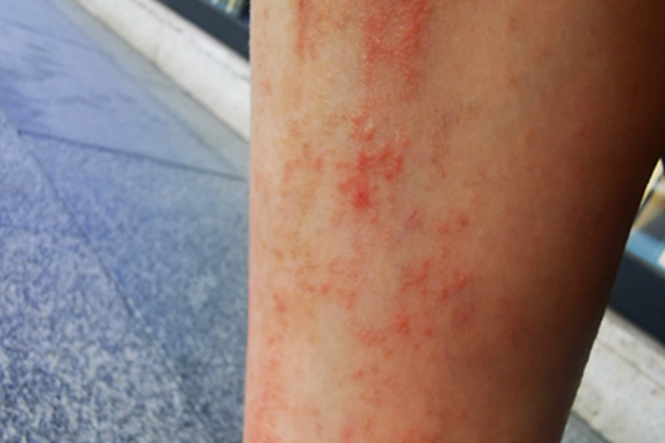 急性接触性皮炎小腿红斑丘疱疹图