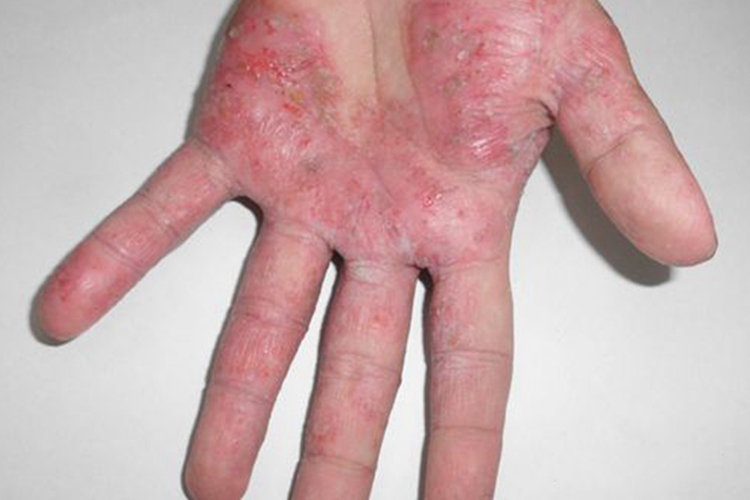 汗疱疹破了感染溃烂图