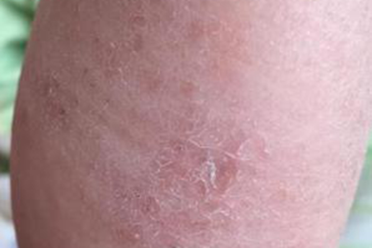 儿童干性湿疹表皮剥脱图