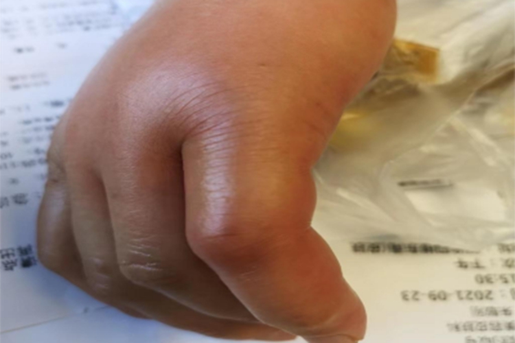 毛虫皮炎手部红肿图