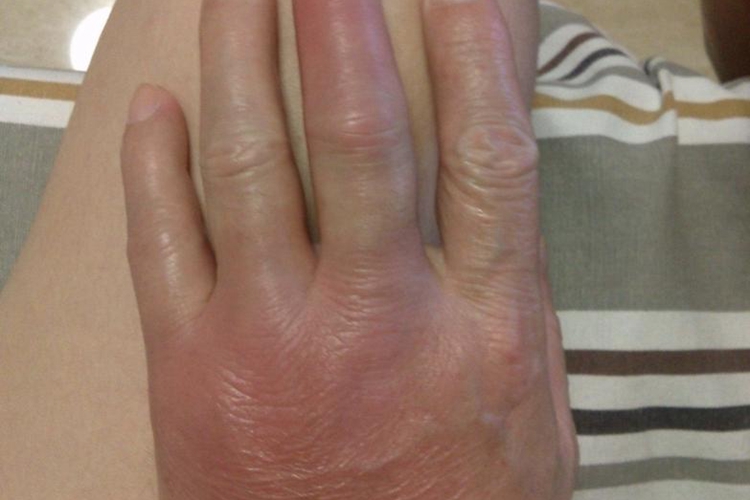 痛风手肿图 痛风手肿图