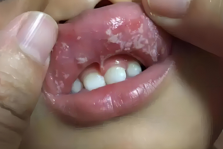 hiv嘴唇鹅口疮图