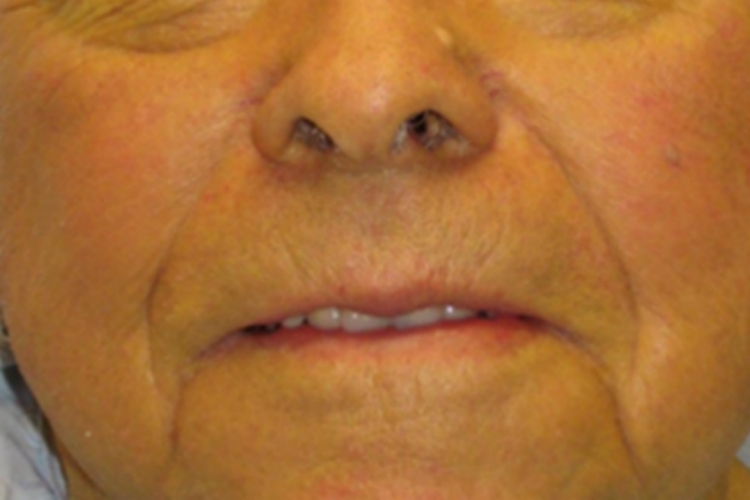 肝硬化面部皮肤发黄图