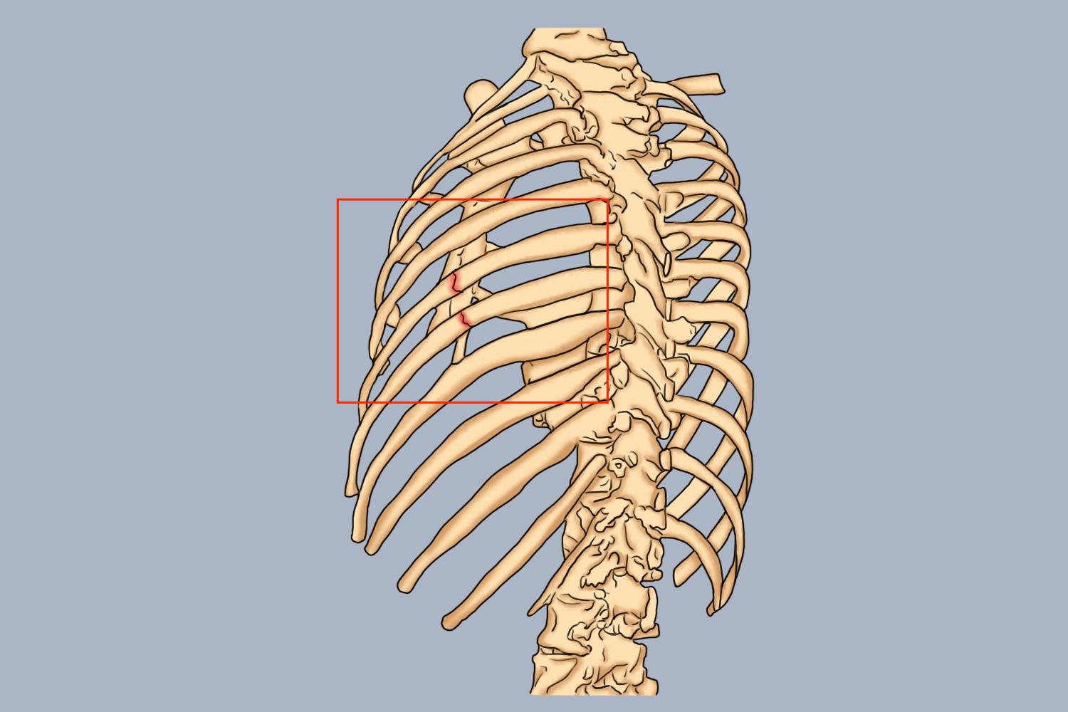 左侧第6-7根肋骨骨折图 左侧第6-7根肋骨骨折图