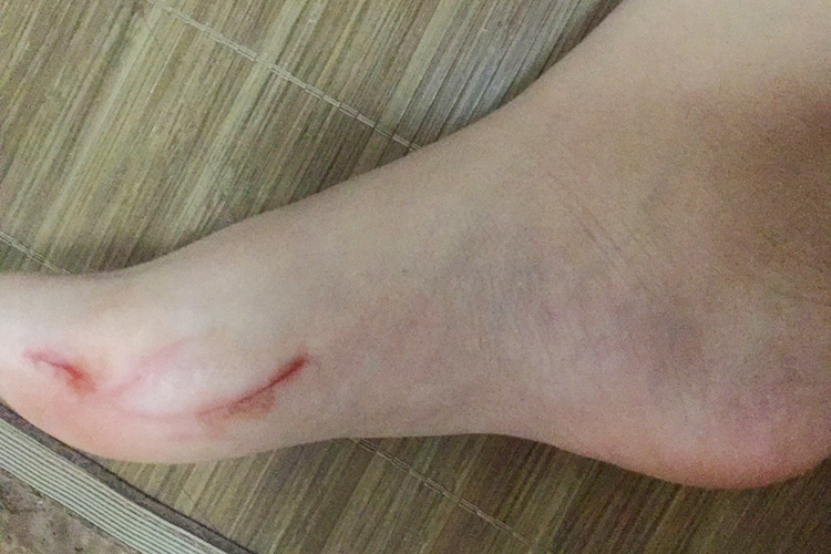 脚被玻璃划伤图