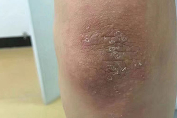 神经性皮炎肘部脱屑图