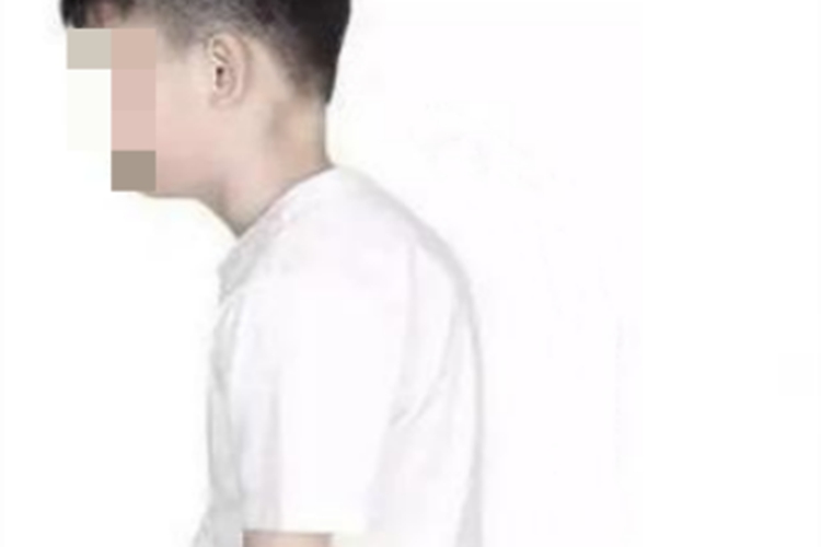 青年性驼背背部症状图 青年性驼背背部症状图