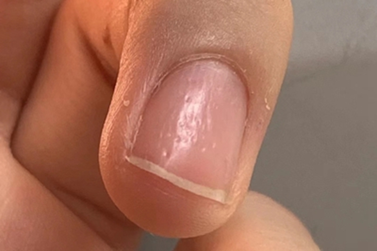 甲凹点手指甲小坑图