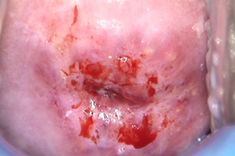 宫颈囊肿症状图