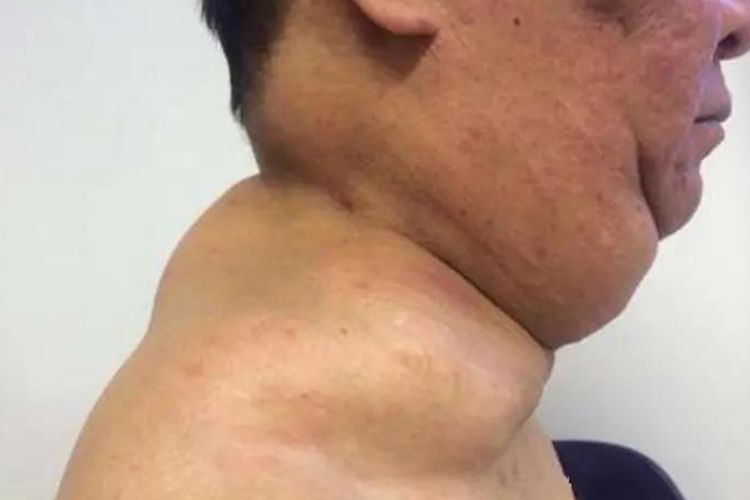 脖子后面脂肪瘤凸出来图