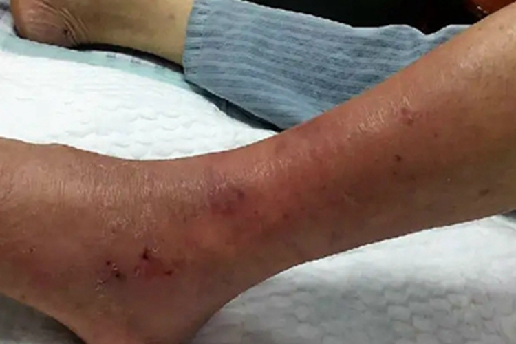 急性期皮肤丝虫病症状图片